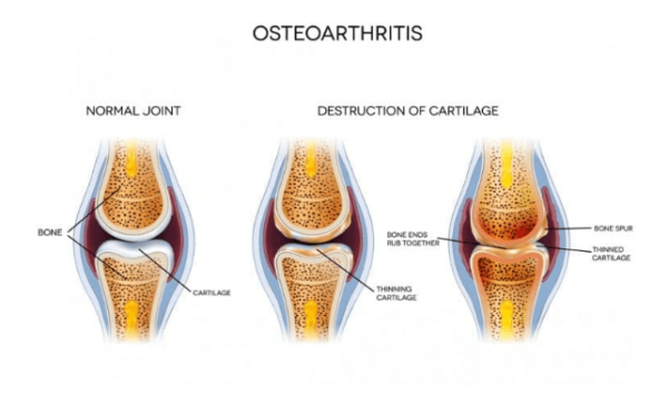 OSTEOARTHRITIS-image